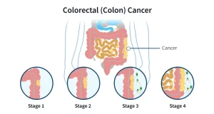 colon-cancer